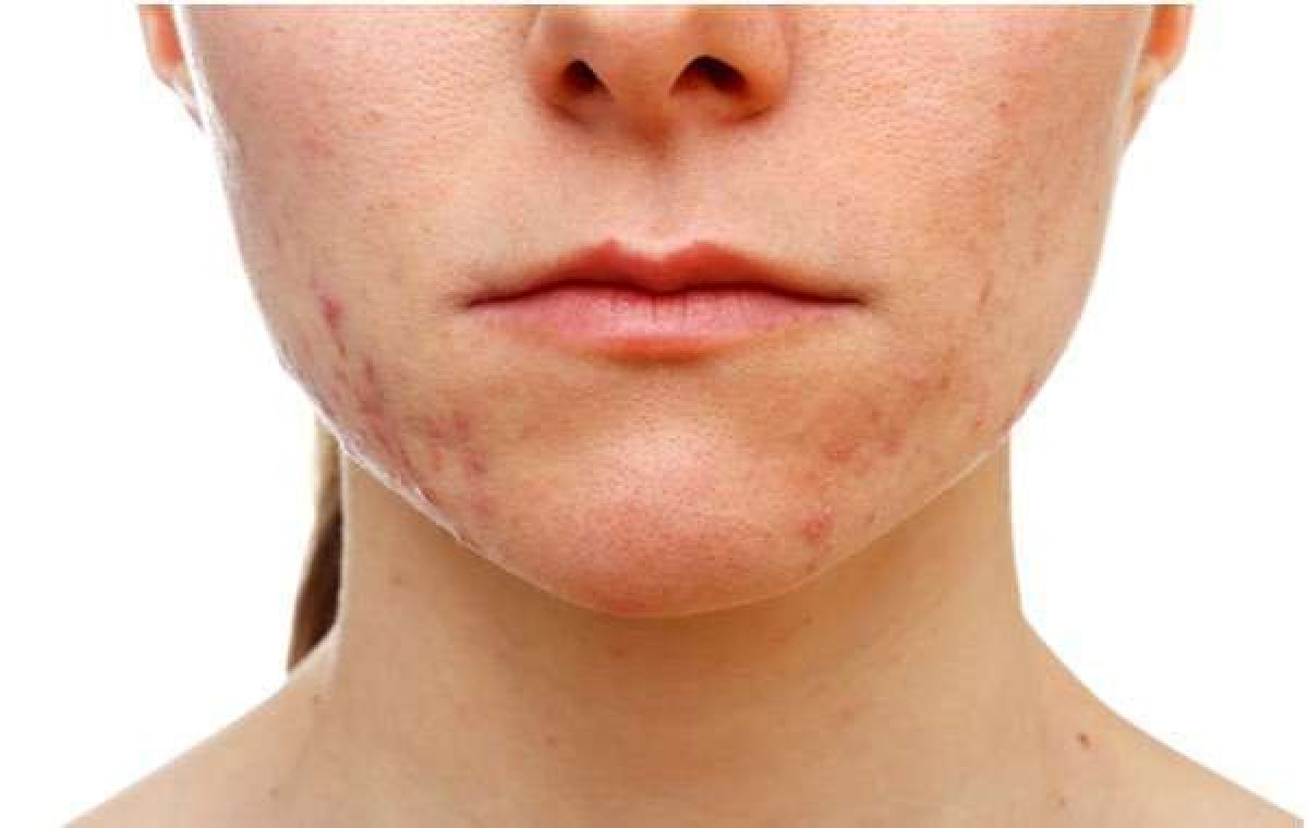 acne ormonale